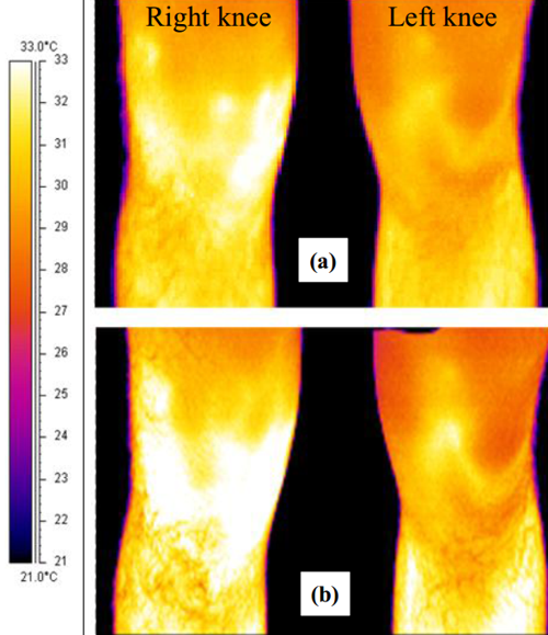 右膝OA運(yùn)動(dòng)員比賽前后左右膝蓋的紅外熱成像